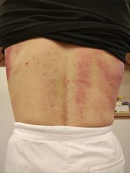 体验后-新蝶变皮肤管理中心