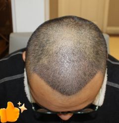 -大麦微针植发丨全国连锁