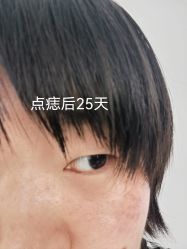 体验后-北京美痣堂古方祛痣斑疣瘊