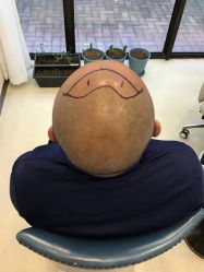 体验前-大麦微针植发丨全国连锁