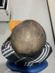 -大麦微针植发全国连锁