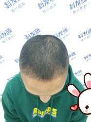 -大麦微针植发丨全国连锁