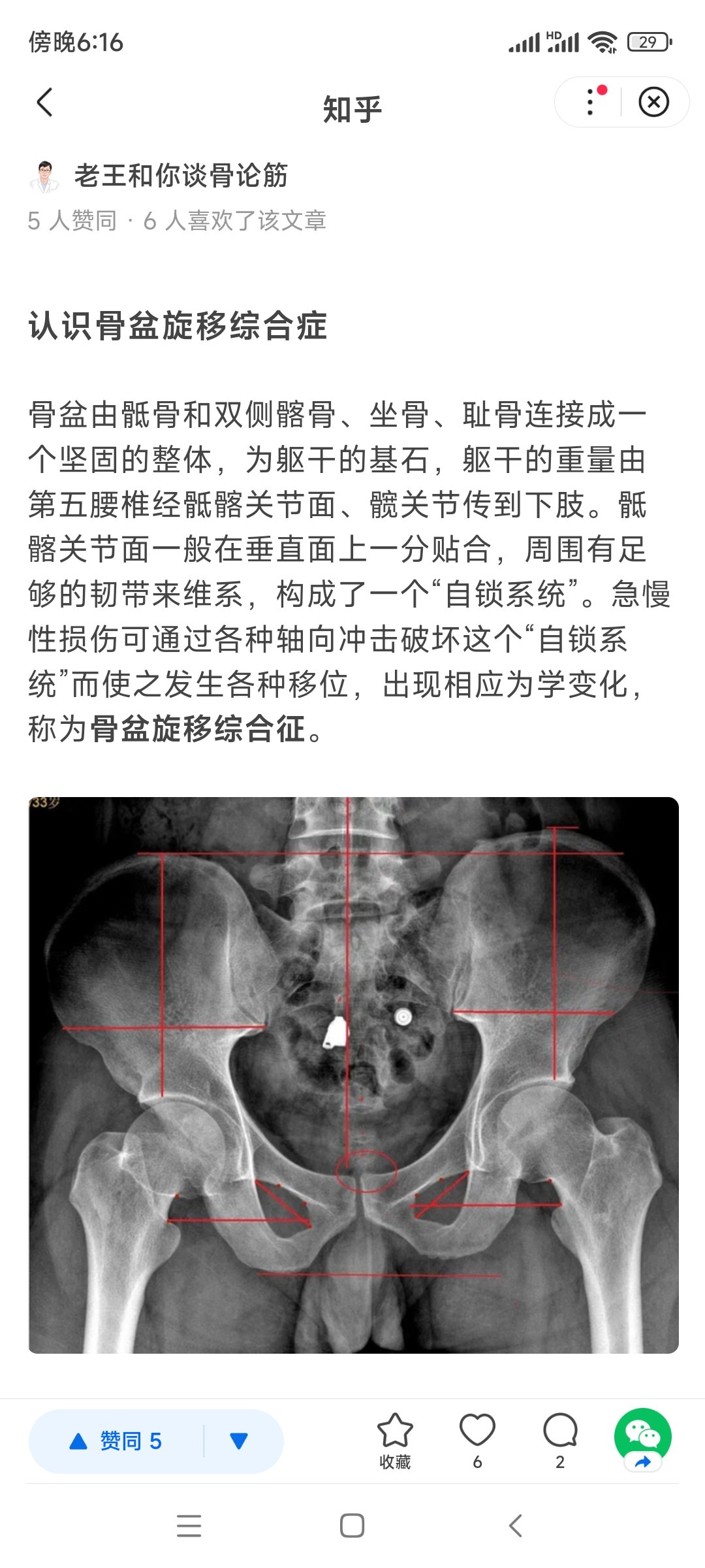 耻骨分离的症状图片图片