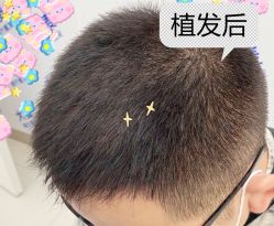 -大麦微针植发全国连锁