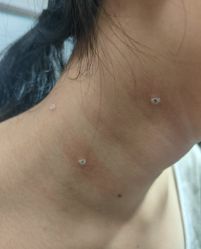 -北京美痣堂古方祛痣斑疣瘊