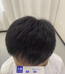 -大麦微针植发全国连锁