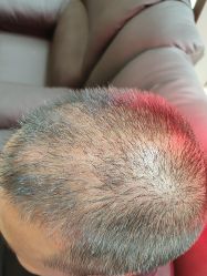 -碧莲盛·不剃发植发