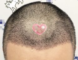 -大麦微针植发全国连锁