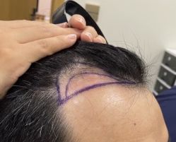 -碧莲盛·不剃发植发