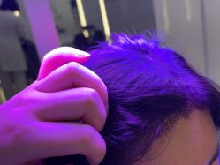 体验后-大麦微针植发全国连锁