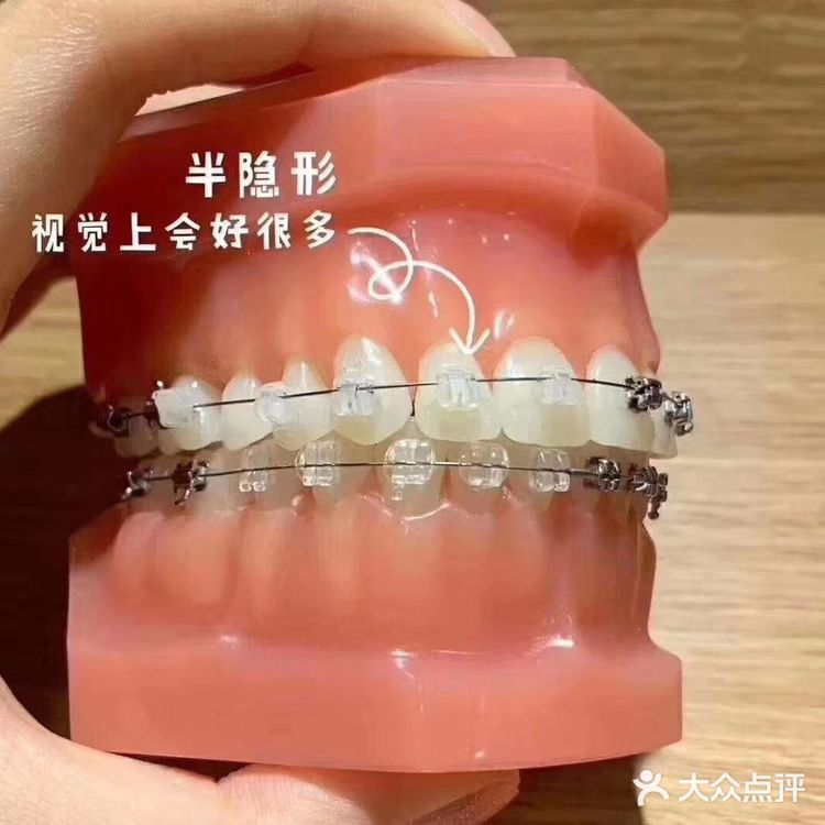 隐形牙套、钢托槽、陶瓷托槽的区别  