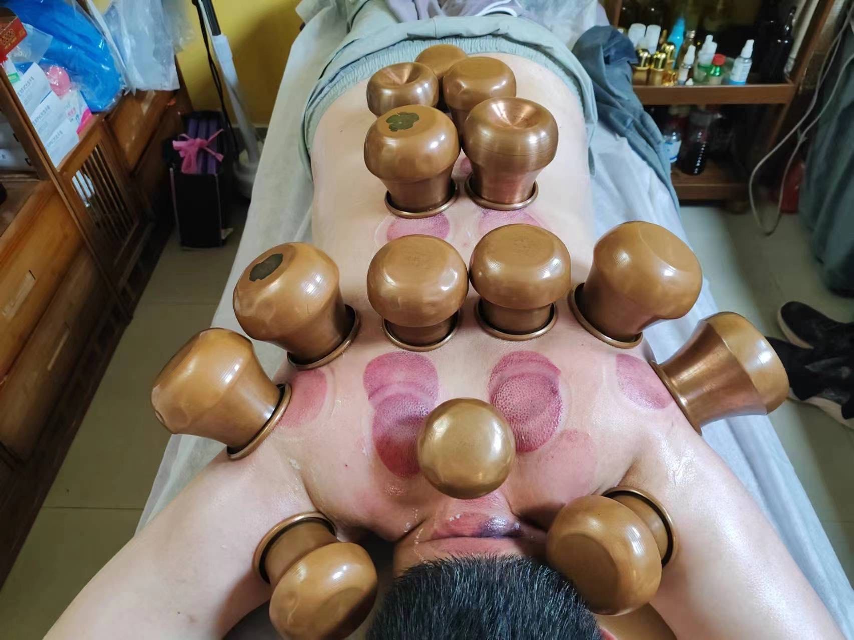 通透舒畅的拔罐和正骨