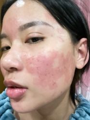 点击看大图 体验后-青岛诺德医学美容医院