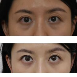 -广州健丽·去眼袋医疗美容机构