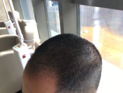 -碧莲盛·不剃发植发