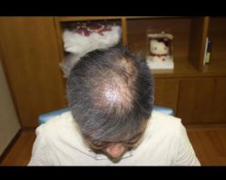 体验前-大麦微针植发全国连锁