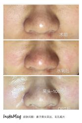 光SPA水氧＋opt-光SPA科技美肤