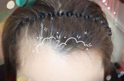 -大麦微针植发全国连锁