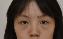 -广州健丽·去眼袋医疗美容机构