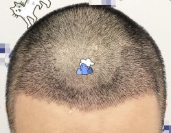 -大麦微针植发全国连锁