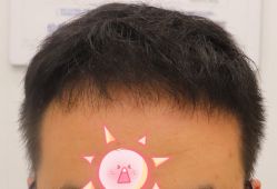 -大麦微针植发全国连锁