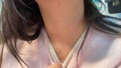 体验后-郡艺医疗美容·微整·眼鼻吸脂