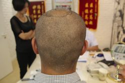 点击看大图 -大麦微针植发丨全国连锁