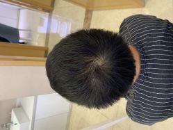 点击看大图 -大麦微针植发丨全国连锁
