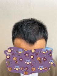 -大麦微针植发全国连锁