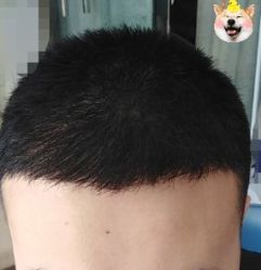 -大麦微针植发丨全国连锁