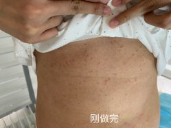 -美丽人生祛斑扁平疣汗管瘤中心