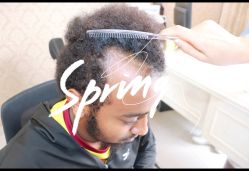 体验前-大麦微针植发全国连锁