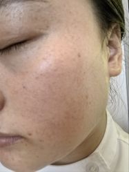 体验前-长沙雅美医疗美容医院