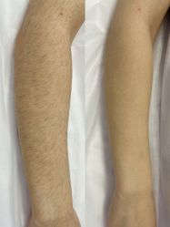 -薇兰专业脱毛连锁机构