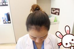 -大麦微针植发丨全国连锁