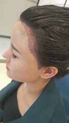 -大麦微针植发丨全国连锁