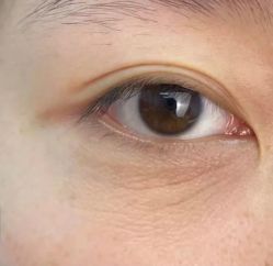 -天津健丽·去眼袋医疗美容机构