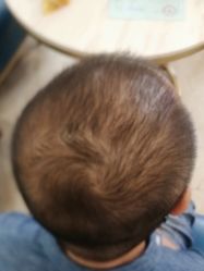 -碧莲盛·不剃发植发