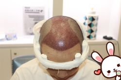 -大麦微针植发丨全国连锁