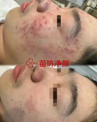 -苗坊净颜痘斑美容护肤连锁