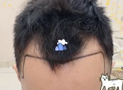 -大麦微针植发全国连锁