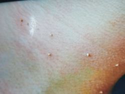 -痣清宫祛斑祛痣连锁店