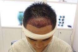 -大麦微针植发丨全国连锁