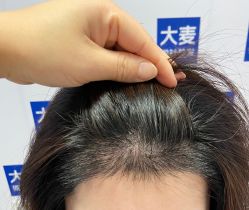-大麦微针植发丨全国连锁