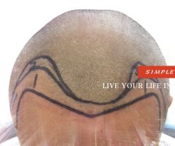 -大麦微针植发全国连锁