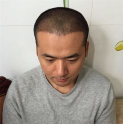 -碧莲盛·不剃发植发