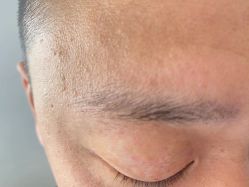 体验后-爱莎扁平疣·汗管瘤·斑痣中心