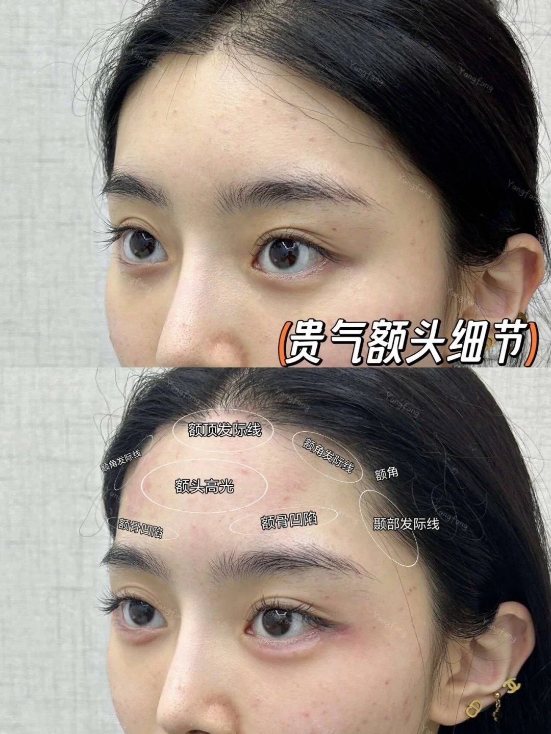高阶方案| 2个关键拿捏宽阔大气额头精髓❗