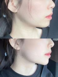 体验前-美安心医美·美迪迈黄金微针·美拉美医疗美容