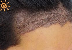 -大麦微针植发丨全国连锁